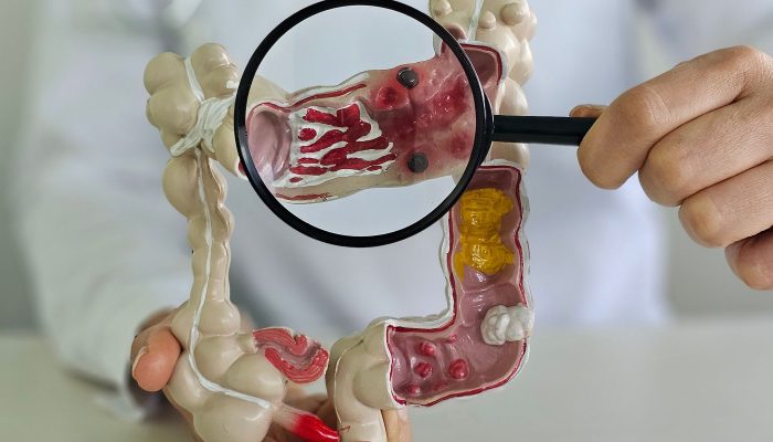 Em 13 anos, doença inflamatória intestinal cresce 5 vezes no Brasil
