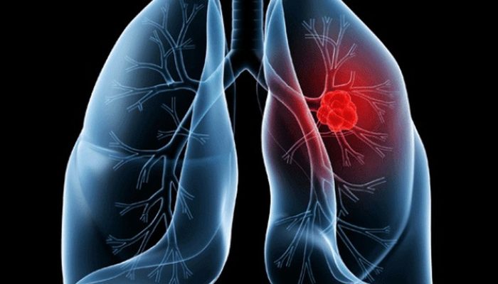 Saiba o que é adenocarcinoma pulmonar, câncer que atinge o Papa Leão