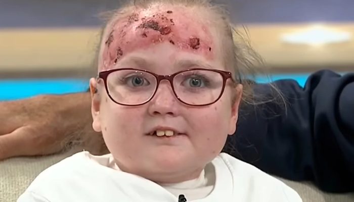 Doença rara deixa menina de 14 anos com bolhas e dor por todo o corpo