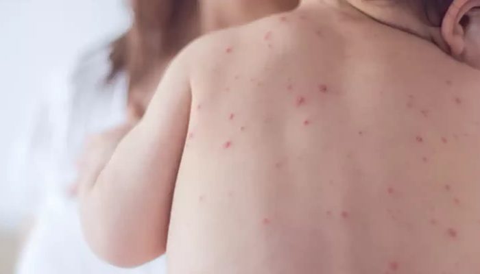 São Paulo confirma mais dois casos de sarampo e total chega a 32